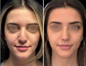 Professional Considerations for Rhinoplasty