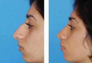 Middle Eastern Rhinoplasty