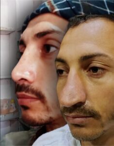 scarless-rhinoplasty