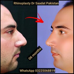 Rhinoplasty Over 40