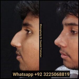 Rhinoplasty for Public Speakers