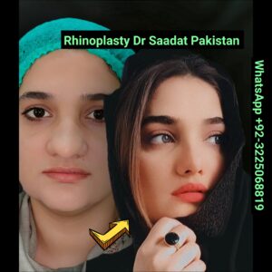 Ultrasonic Rhinoplasty