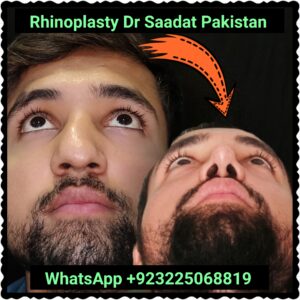 Latest Rhinoplasty Innovations