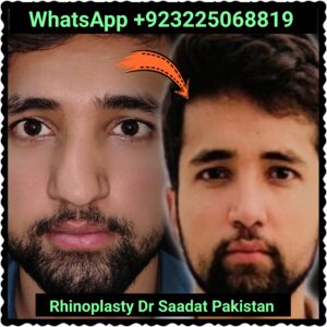 Open vs Closed Rhinoplasty