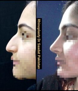 Preservation Rhinoplasty