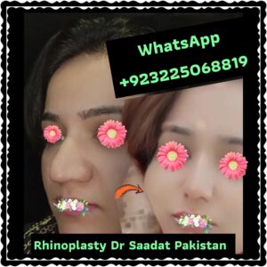 South Asian Rhinoplasty